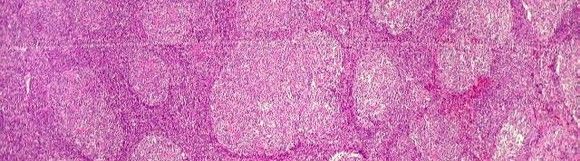 El cáncer de un subcontratado fue de origen laboral