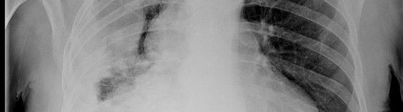 mesotelioma