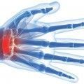 sindrome_tunel_carpiano