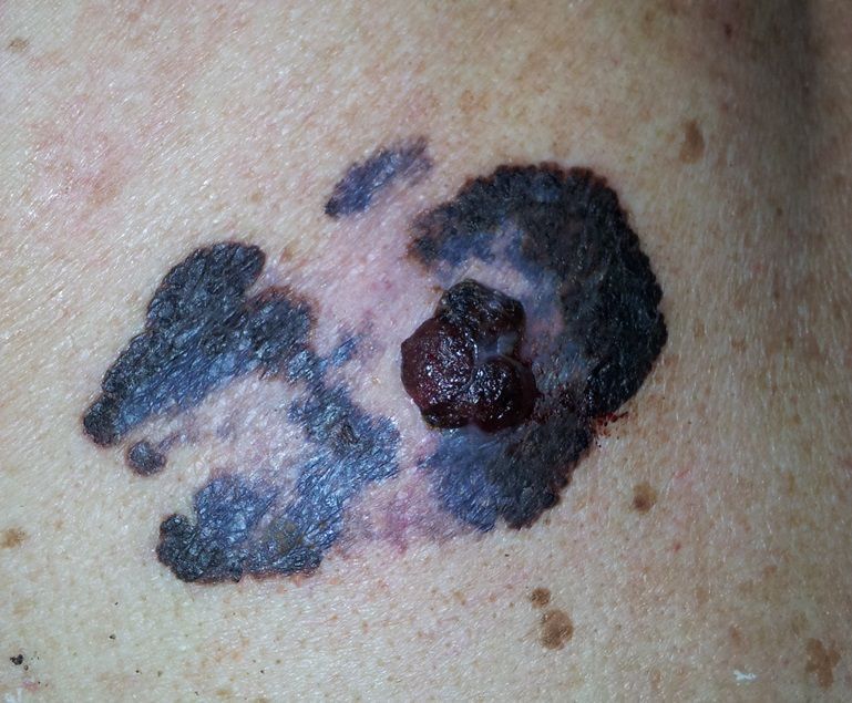 Cáncer cutáneo por exposición ocupacional a agentes químicos
