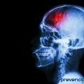 El estrés podría aumentar el riesgo de accidente cerebrovascular