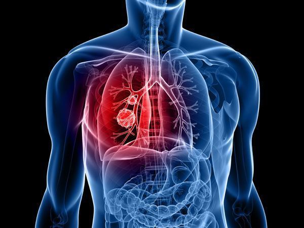 Nueva investigación sobre la rehabilitación y la reincorporación al trabajo después del cáncer