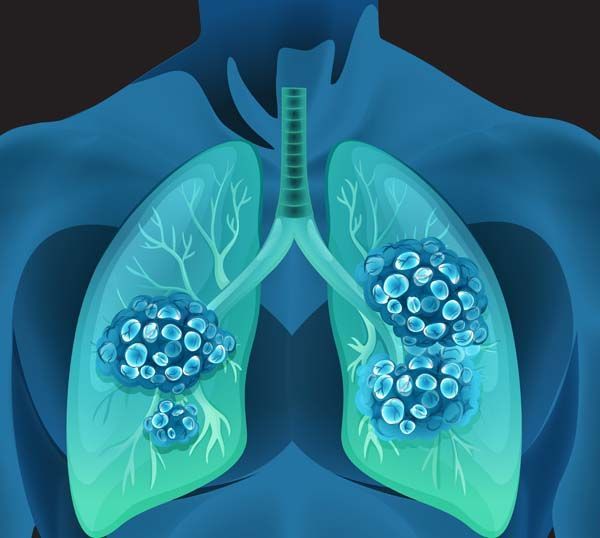 Nueva enfermedad profesional: el cáncer de pulmón por inhalación de sílice