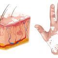 dermatosis