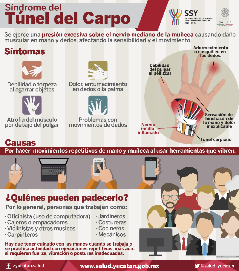 Infografía: Síndrome del túnel carpiano