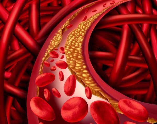 ¿Qué son las enfermedades cardiovasculares?