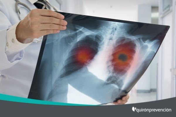 Cáncer de pulmón de origen laboral