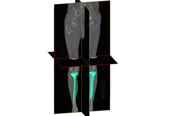 IBV investiga en productos y servicios sanitarios para el tratamiento de enfermedades osteoarticulares con Inteligencia Artificial y 3D