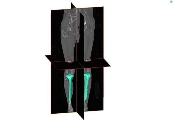 IBV investiga en productos y servicios sanitarios para el tratamiento de enfermedades osteoarticulares con Inteligencia Artificial y 3D