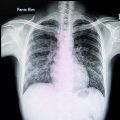 Neumoconiosis