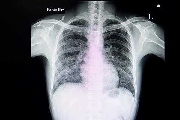 Clasificación Internacional de la OIT de Radiografías de Neumoconiosis